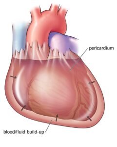 Cardiac tamponade