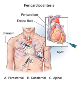 Pericardiocentesis