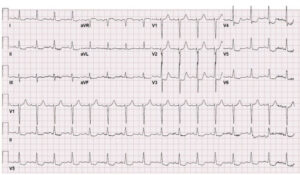 ECG