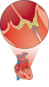 Bacterial endocarditis