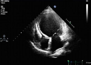 Two-dimensional transthoracic echocardiography of dilated cardiomyopathy