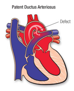 Patent ductus arteriosus