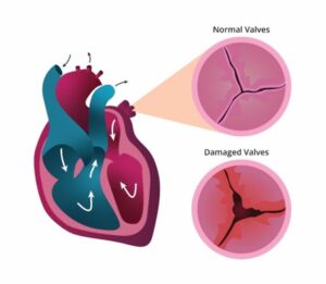 Endocarditis affect valves