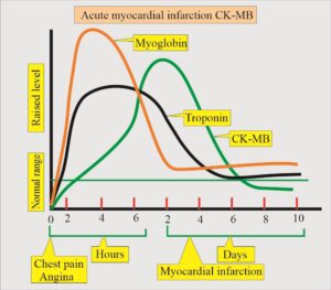 إنزيمات القلب في متلازمة الشريان التاجي الحادة