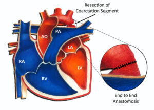 Resection with end-to-end anastomosis