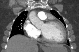 CT scan show Dilated cardiomyopathy