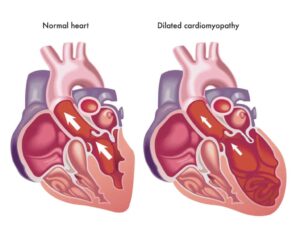 Dilated cardiomyopathy