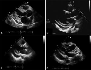 Echocardiographic grading of pericardial effusion