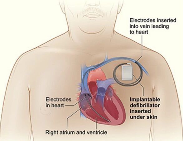التعايش مع جهاز تنظيم ضربات القلب 