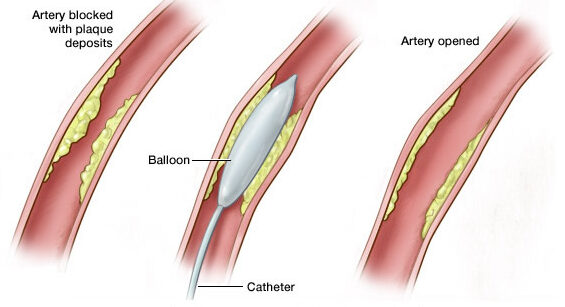 إصلاح انسداد الشريان التاجي عن طريق البالون 
