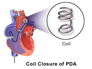 Coil Closure of PDA