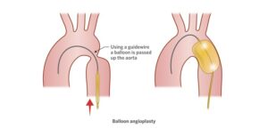 Balloon angioplasty