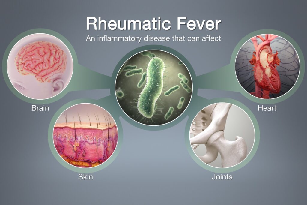 الحمى الروماتيزمية