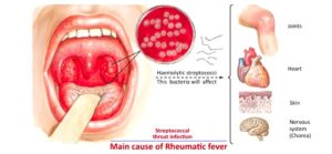 Causes of Rheumatic fever