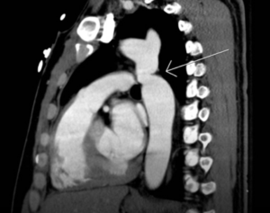 Coarctation of the aorta CT