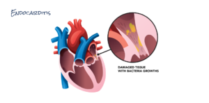 Infective endocarditis