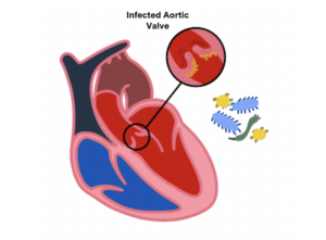 Infected Aortic Valve