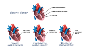 أنواع اعتلال عضلة القلب