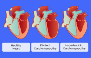 Cardiomyopathy