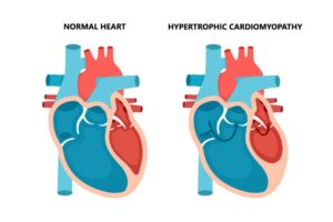 Hypertrophic cardiomyopathy