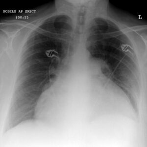 Cardiac tamponade on Chest X-Ray