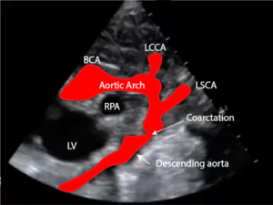 Coarctation of the aorta Echo