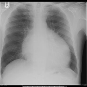 Pericardial effusion on Chest X-Ray