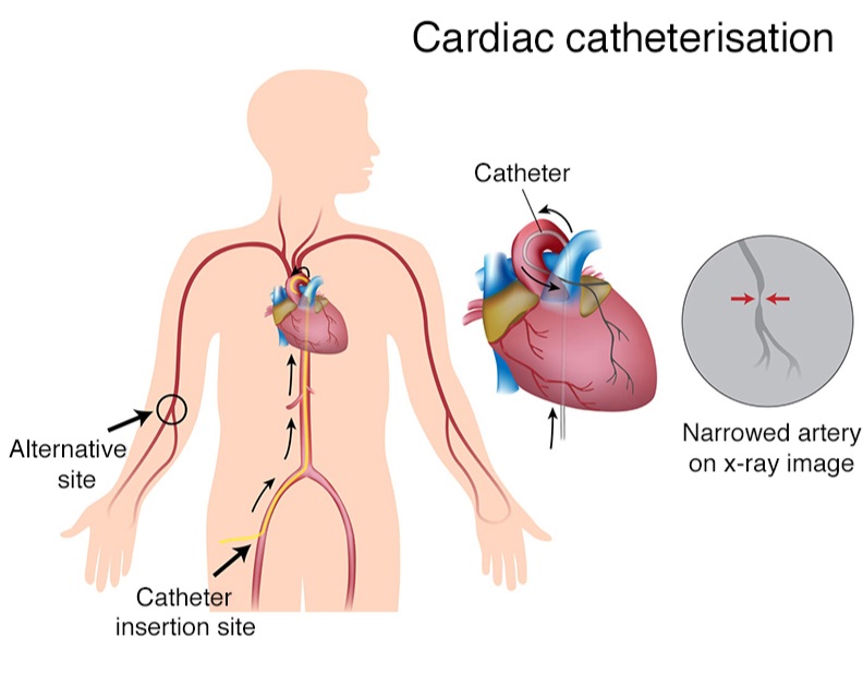 قسطرة القلب 