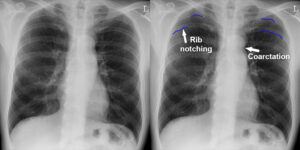 Coarctation of the aorta X-Ray