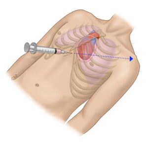 Pericardiocentesis