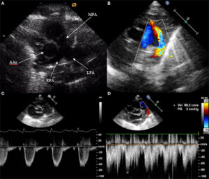 Echocardiographic Evaluation of PDA