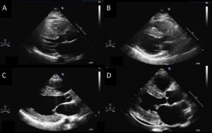 Echocardiogram show Hypertrophic cardiomyopathy