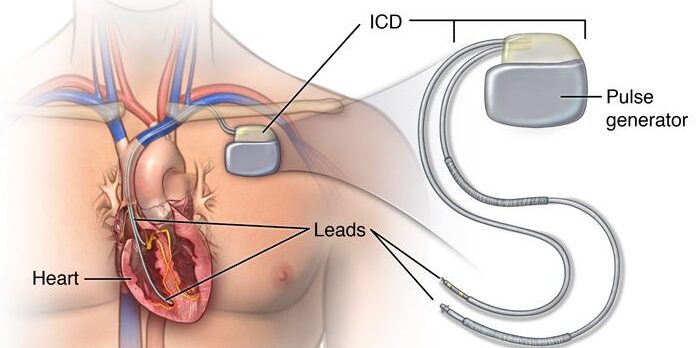 التعايش مع جهاز تنظيم ضربات القلب