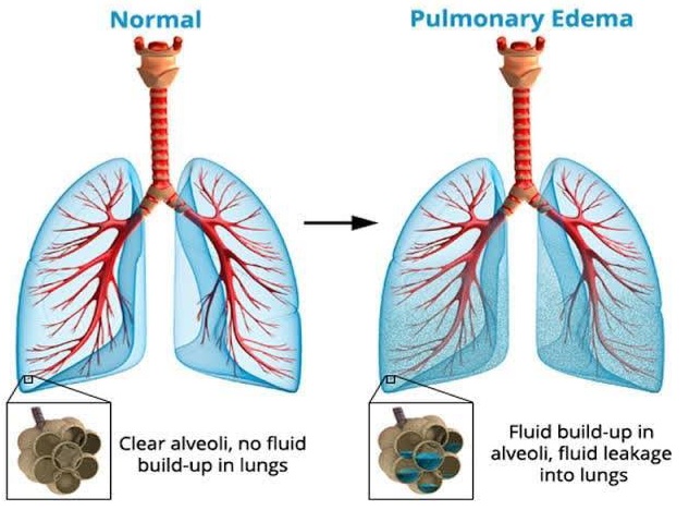 الوذمة الرئوية 