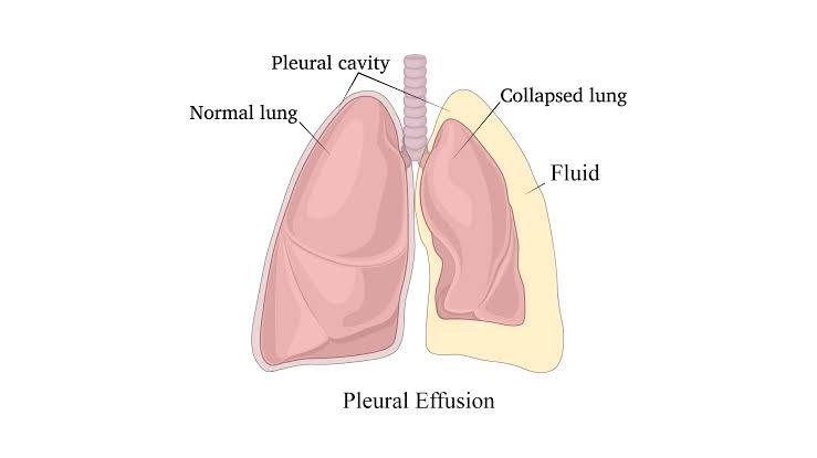 Pleural effusion 