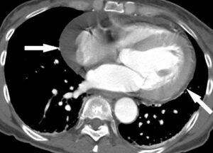 Cardiac tamponade on CT