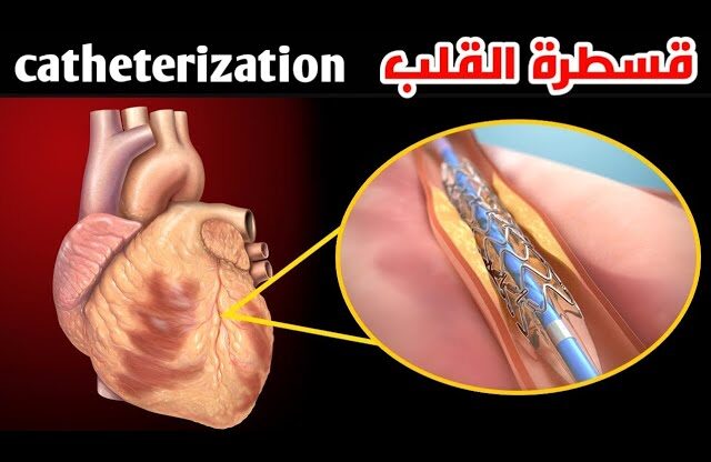 هل عملية قسطرة القلب خطيرة