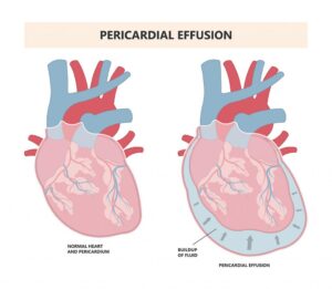 Pericardial effusion