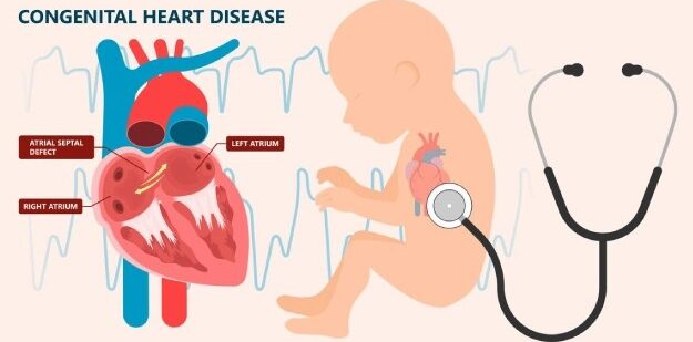 عيوب القلب الخلقية عند حديثي الولادة
