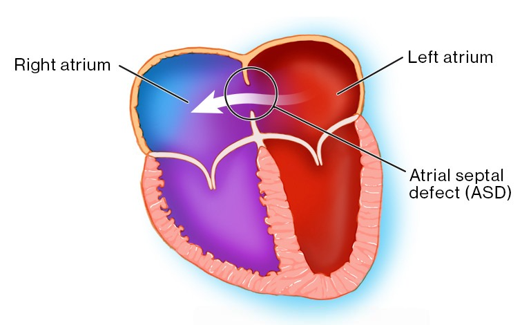 عيب في الحاجز الأذيني 