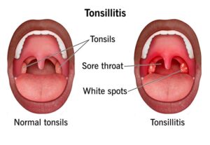 Tonsillitis