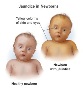 اليرقان أو الصفار (Jaundice)