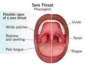 Pharyngitis