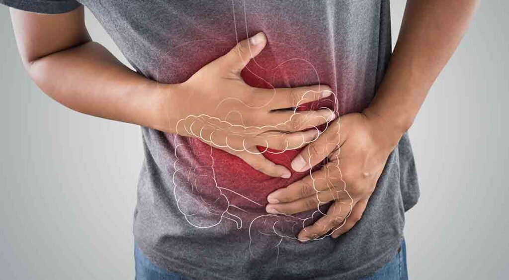 التهاب القولون التقرحي - Ulcerative Colitis