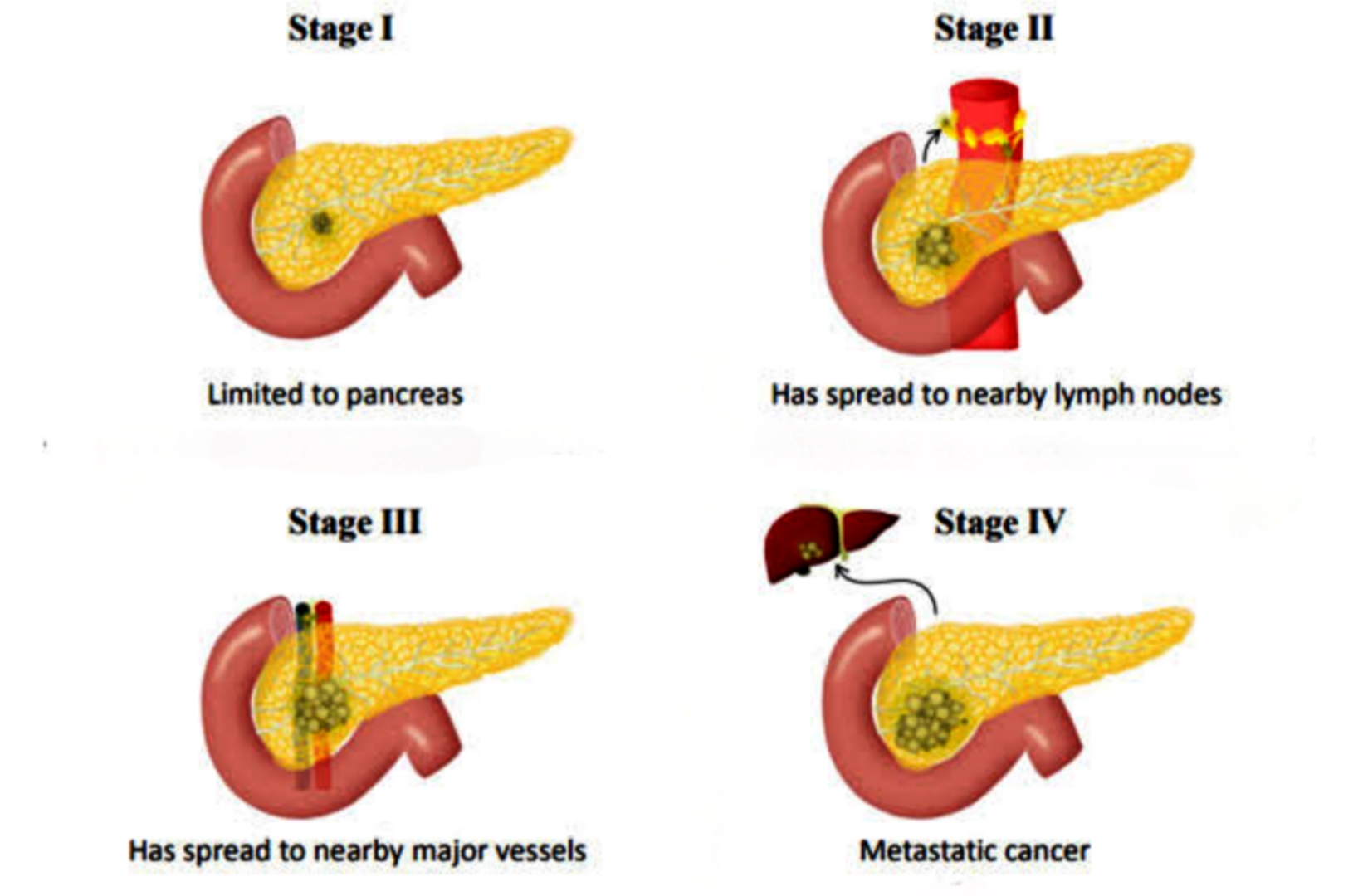 مراحل سرطان البنكرياس 