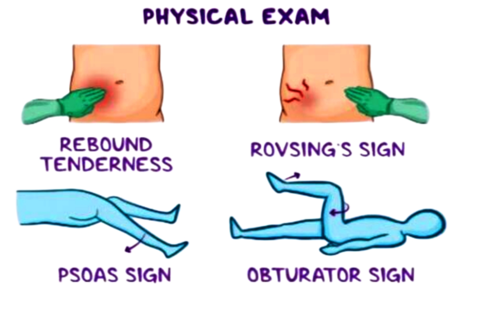 Sign of Appendicitis 