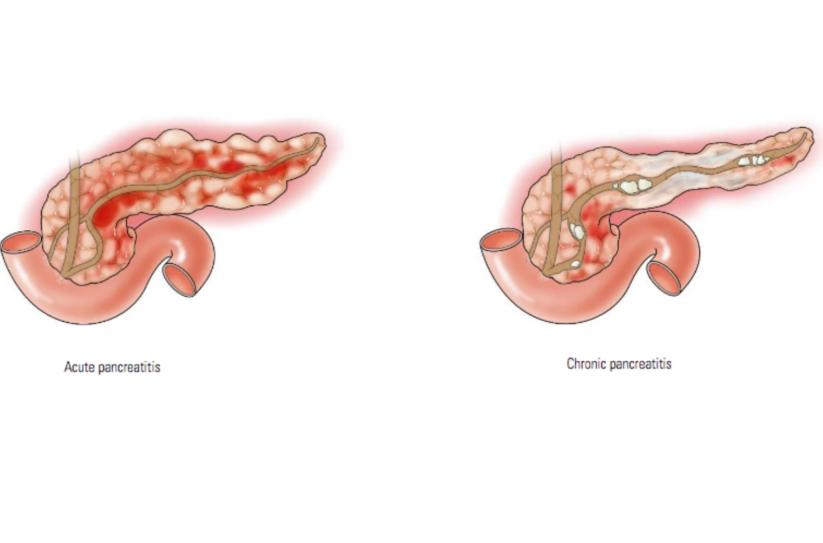 الفرق بين التهاب البنكرياس الحاد والمزمن 