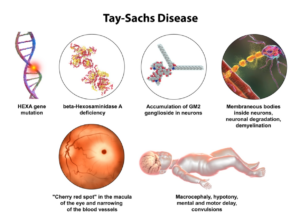 Tay-Sachs Disease