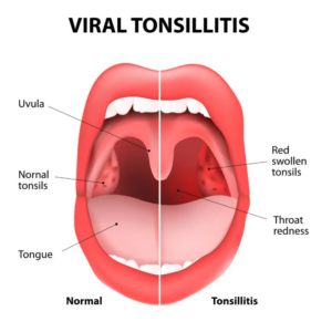 Viral tonsillitis