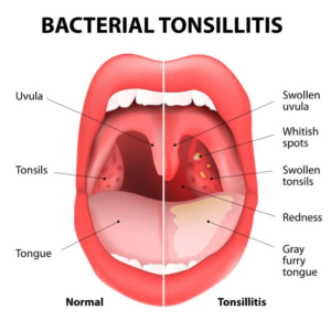 Bacterial tonsillitis